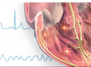 What the brain is telling the heart: Cardiac electrophysiological and molecular alterations in Parkinson’s disease